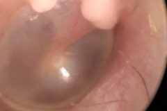 Osteomas, roof of R ear canal at usual sites near TM.