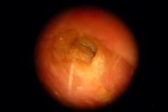 Otitis externa