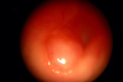 Polyp in ear canal