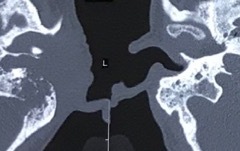 Squamous carcinoma (1), CT right ear, 65y male.