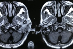 Squamous carcinoma (1), MRI right temporal bone, 65y male.