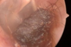 Wax and hair in R ear canal, non-obstructive, incidental finding, normal, or may be due to attempt to clean with cotton bud.