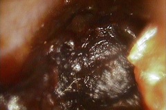 Wax obstructing right ear canal.