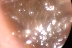 Wax, almost occluding left ear.