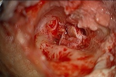 Atticotomy, R ear, (3), extended back to remove incus and expose antrum and remove remainder of cholesteatoma sac.