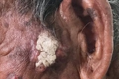 Basal cell carcinoma, left cheek, 80y male.
