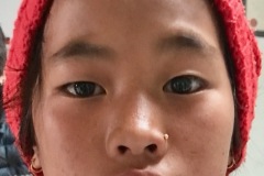 Bell's palsy, R side, onset x 10/7, 10 y girl, at rest.