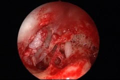 Exposed horizontal facial nerve, found during attico-antrostomy and tympanoplasty, L ear.