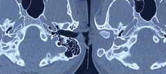 Iatrogenic complete facial palsy and dead ear immediately after R mastoidectomy, undrenwet revison mastoidectomy, with facial nerve graft and cavity obliteration, 22y female, axial CT scan.