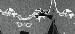 Iatrogenic complete facial palsy and dead ear immediately after R mastoidectomy, undrenwet revison mastoidectomy, with facial nerve graft and cavity obliteration, 22y female, coronal CT scan.