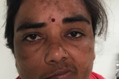 Total right palsy, iatrogenic after mastoid surgery, at rest.