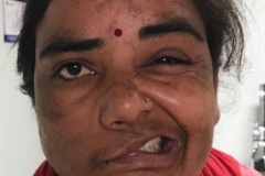 Total right palsy, iatrogenic after mastoid surgery, grimace.