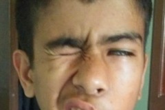 facial palsy, left ear, surgical complication, young boy, grimace.