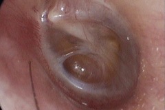 Glue ear, partially retracted and pocketed TM, L ear.
