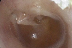 Glue ear, dull drum, retracted TM, postero-superior pocket touching LPI, L ear.