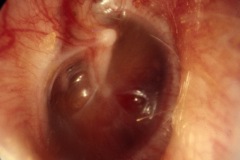 Glue ear, dull TM, retraction pockets, touching LPI, R ear.