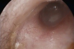 Dull drum, middle ear effusion, R ear.