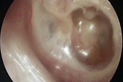 Glue ear, Dull TM, chronic, Posterior pocket retracted onto stapes, eroded long process of incus, L ear.