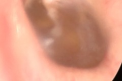 Glue ear, left ear, drum brown due to middle ear fluid.