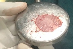 Temporalis Fascia autologous graft, prepared for ear drum repair.