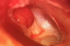 Granulations / small polyps, in attic erosion due to active attic cholesteatoma, R ear.