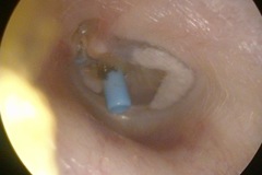 T-Tube, Tympanosclerotic patches in TM, left ear.