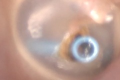 T Tube, R ear.