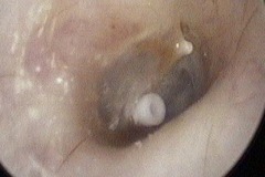 Teflon Grommet in R ear drum.