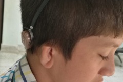 Bone conducting hearing aid on 'Alice' head band, Microtia, atresia, bilateral, conduvctive hearing loss