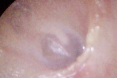 Congenital bilateral conductive hearing loss 50dB, pre-op, at surgery annulus bone found to be fixing malleus and incus, stapes normal,12y boy, R ear.