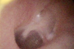 Congenital bilateral conductive hearing loss 50dB,12y boy, R ear, unoperated.