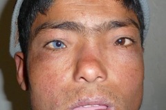 Heterochromia Iridis, congenital nerve deafness