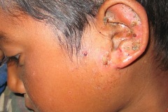 Chronic ear discharge, CSOM, secondary pinna skin infection
