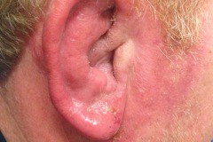 Perichondritis of Pinna.