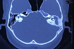 Lateral semicircular canal fistula due to cholesteatoma, Axial CT, R non-hearing ear, adult female.