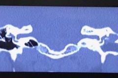Lateral semicircular canal fistula due to cholesteatoma, Coronal CT, R non-hearing ear, adult female.