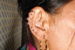 Scarring and inflammatory nodules around bamboo 'keepers' in pinna helix piercings.