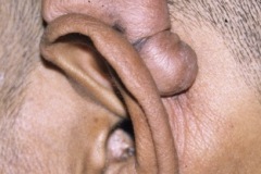 Keloid in postauricular surgical scar 2.