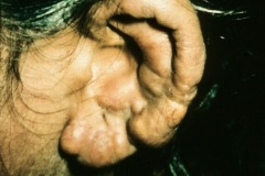 Leprosy, nodular skin on pinna.