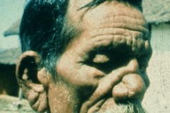Leprosy, lepromatous, leonine facies, thickened creased skin of all face, brows and pinna.