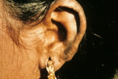 Leprosy, lepromatous type, gross thickening of skin of pinna.