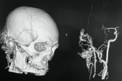 Arterio-venous malformation, causing slowly enlarging pulsatile mass and vessels on, and inferior to,R pinna, male approx 35 years