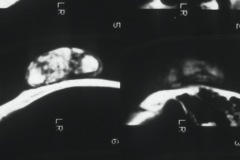 Osteoma of squamous temporal bone, elderly man X-ray