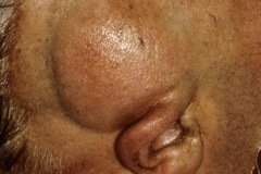 Osteoma of squamous temporal bone, elderly man