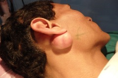 Sebaceous cyst behind ear lobe