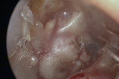 Partially obliterated mastoid cavity and attic, cartilage grafts visble in attic and through tympanic membrane, dry cavity, R ear, A