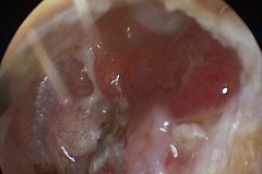 Wet granular mastoid cavity, L ear