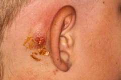 Mastoid abscess fistula, young boy, R ear