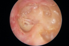 Mastoid cavity left ear, dry