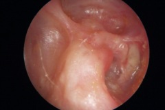 Mastoid cavity right ear, wet pocket in TM, granulation on facial ridge